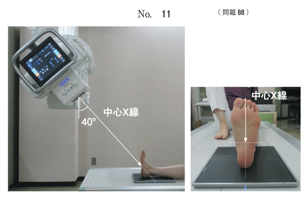 踵骨軸位撮影ポジショニング図